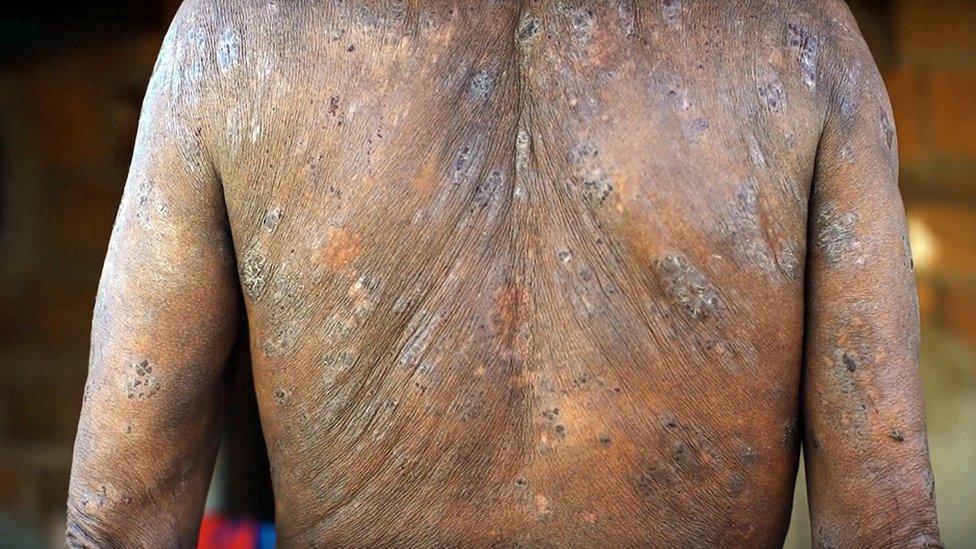 A worker who says his back was damaged by pesticides