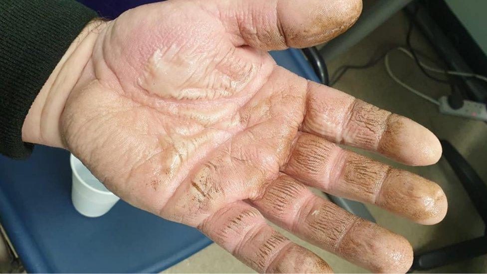 Myles Charles' burnt hand