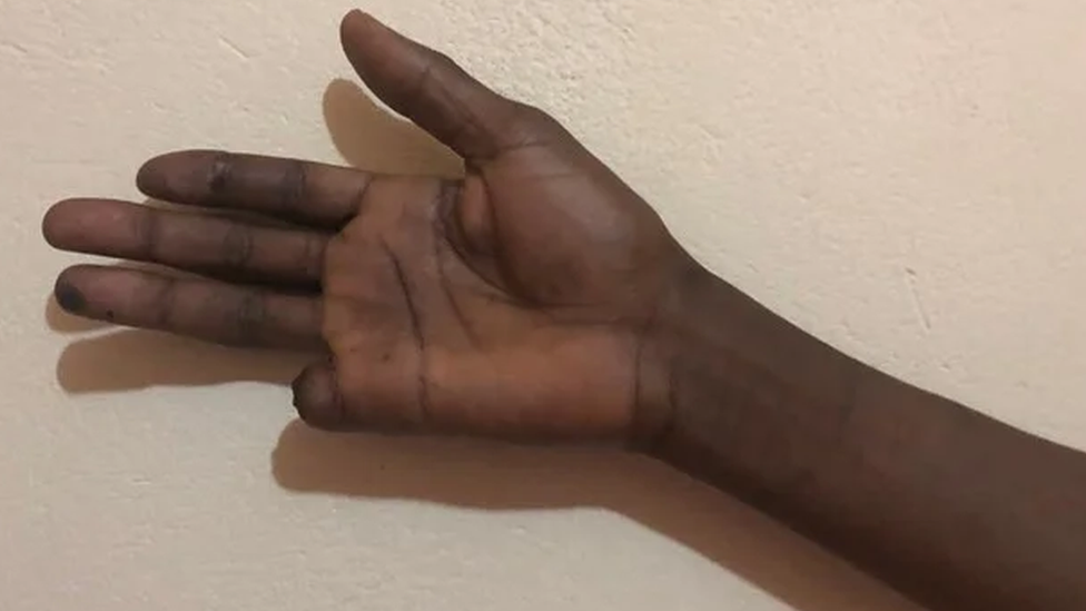 Mahamat Nour Mamadou's right hand, showing a finger missing