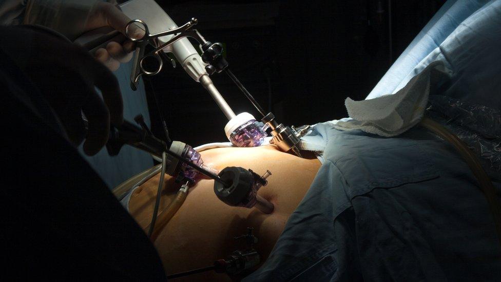 Laparoscopic operation