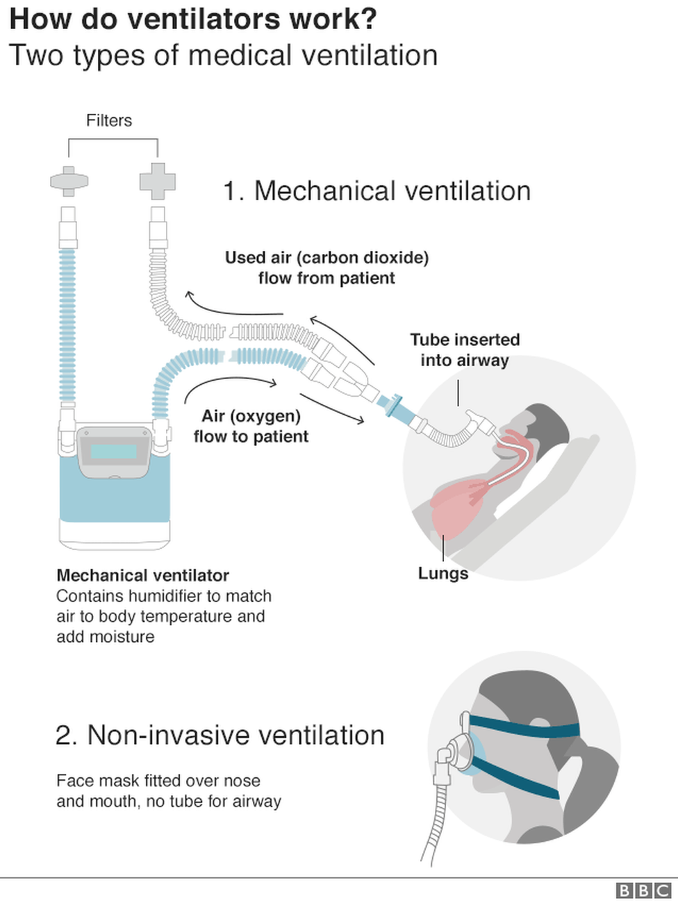 Graphic showing two common types of medical ventilation