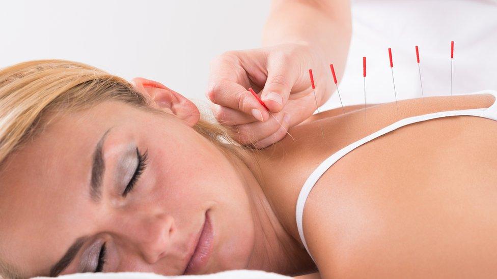 A woman having acupuncture