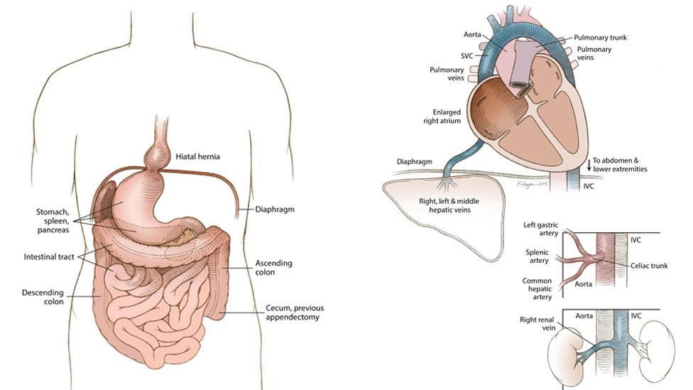 Medical illustration of situs inversus with levocardia