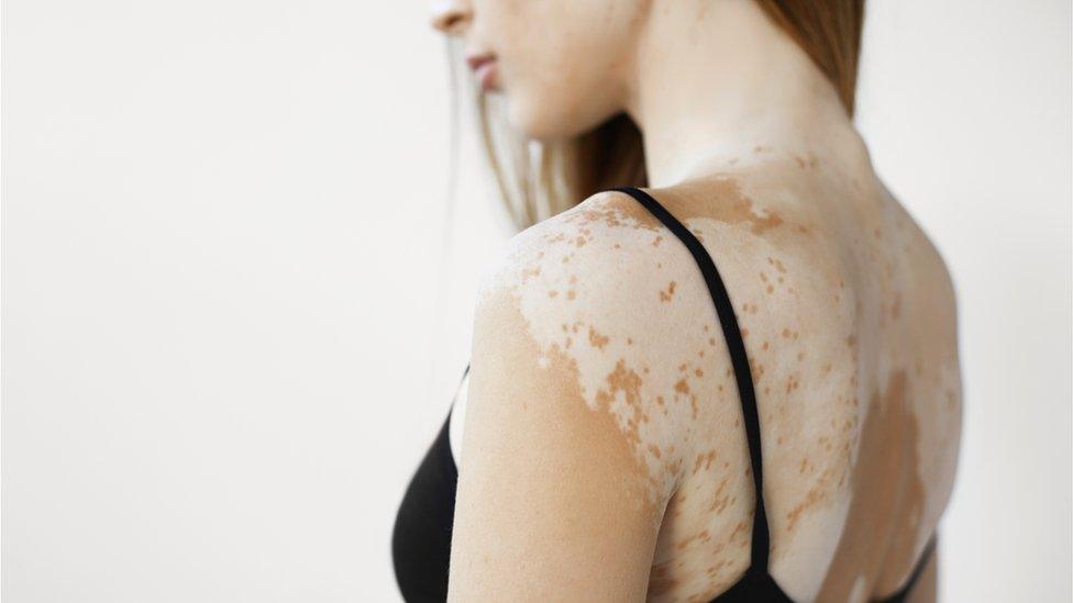 a-woman-with-vitiligo