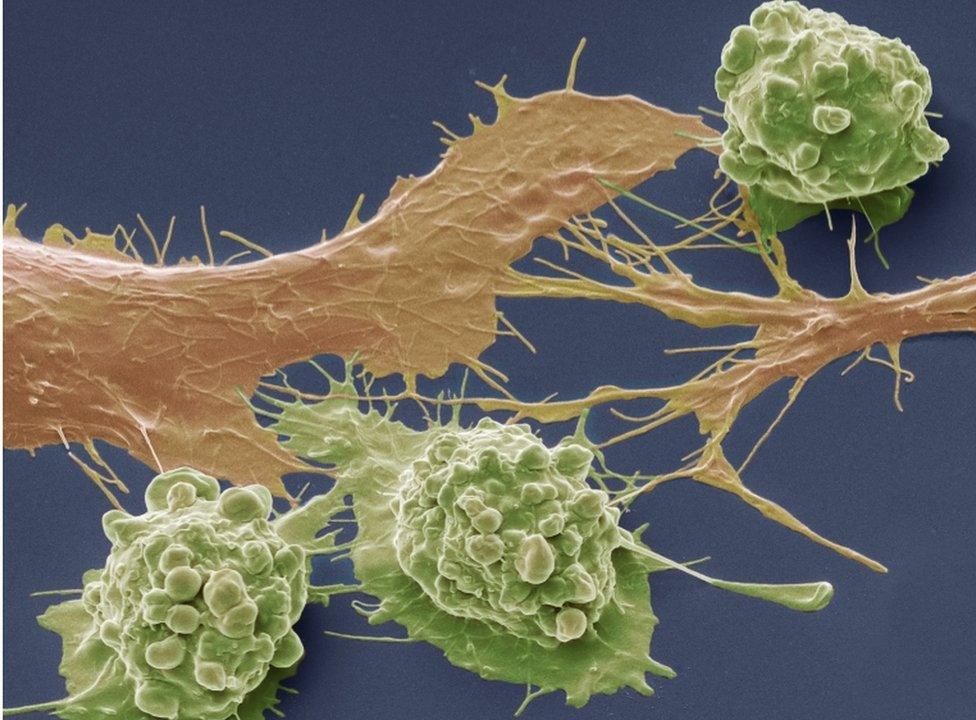 Bowel cancer cells