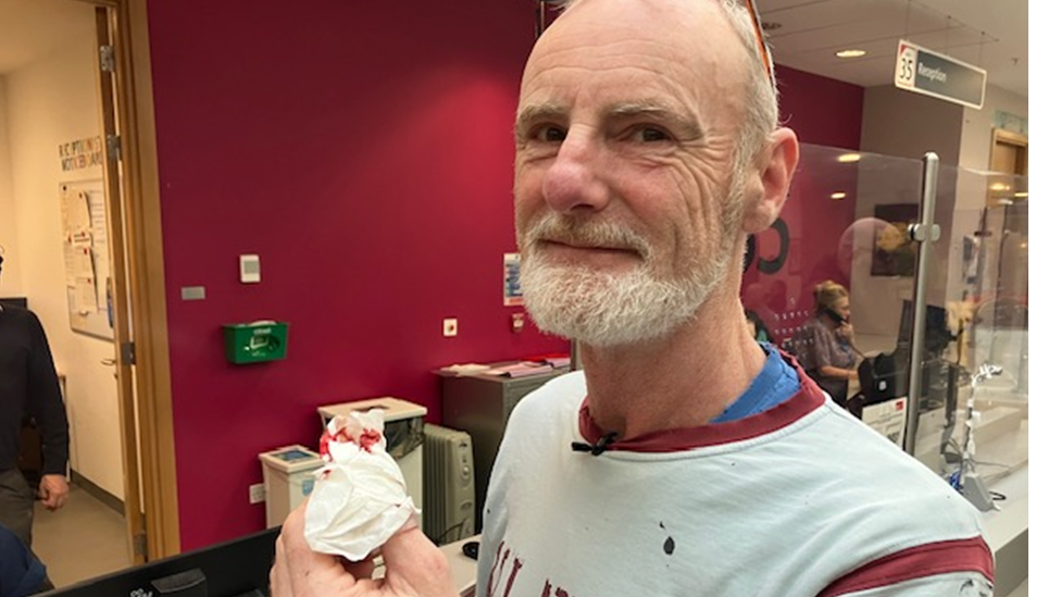 Richard Hawkins with his injured thumb wrapped in a bandage with blood showing