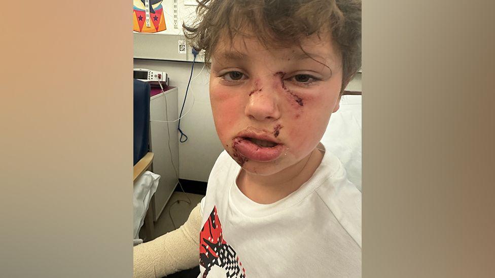Weston has brown hair and brown eyes. He has a long cut under the right eye and across the bridge of his nose. His lower lip is swollen and twice the size of his upper lip. There are cuts around his mouth and on his chin. He is wearing a white t-shirt and a bandage covers the left arm. He is sitting on a hospital bed.