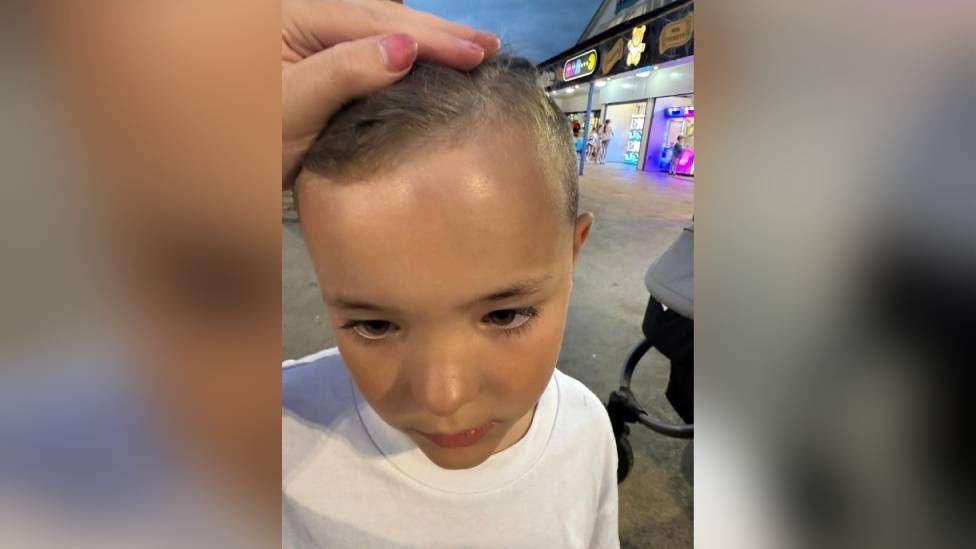 Ethan looking down as the photo is taken. His hairline is being held back by someone with their hand resting on his head. It reveals his forehead which appears bruised and is darker in colour on the left side of his forehead.