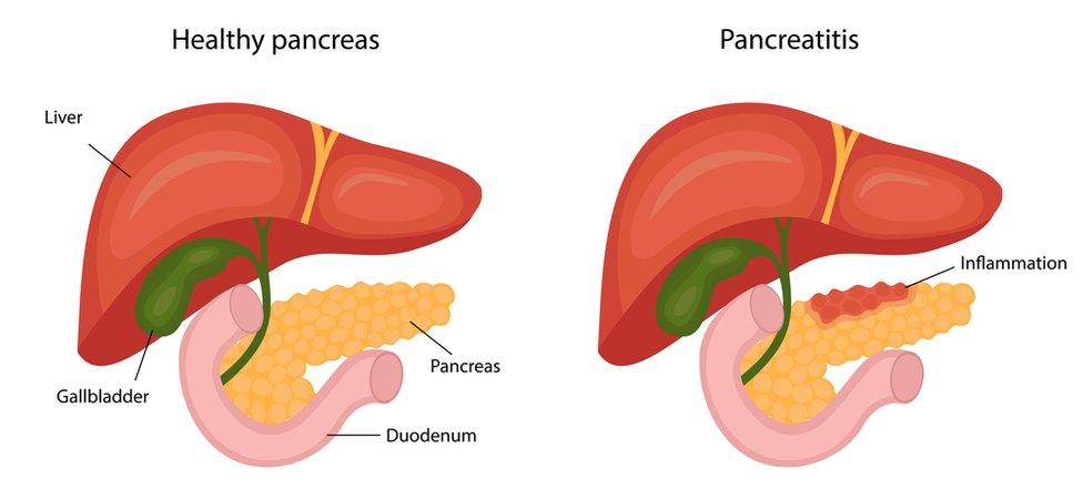 Diagram showing healthy pancreas and pancreatitis