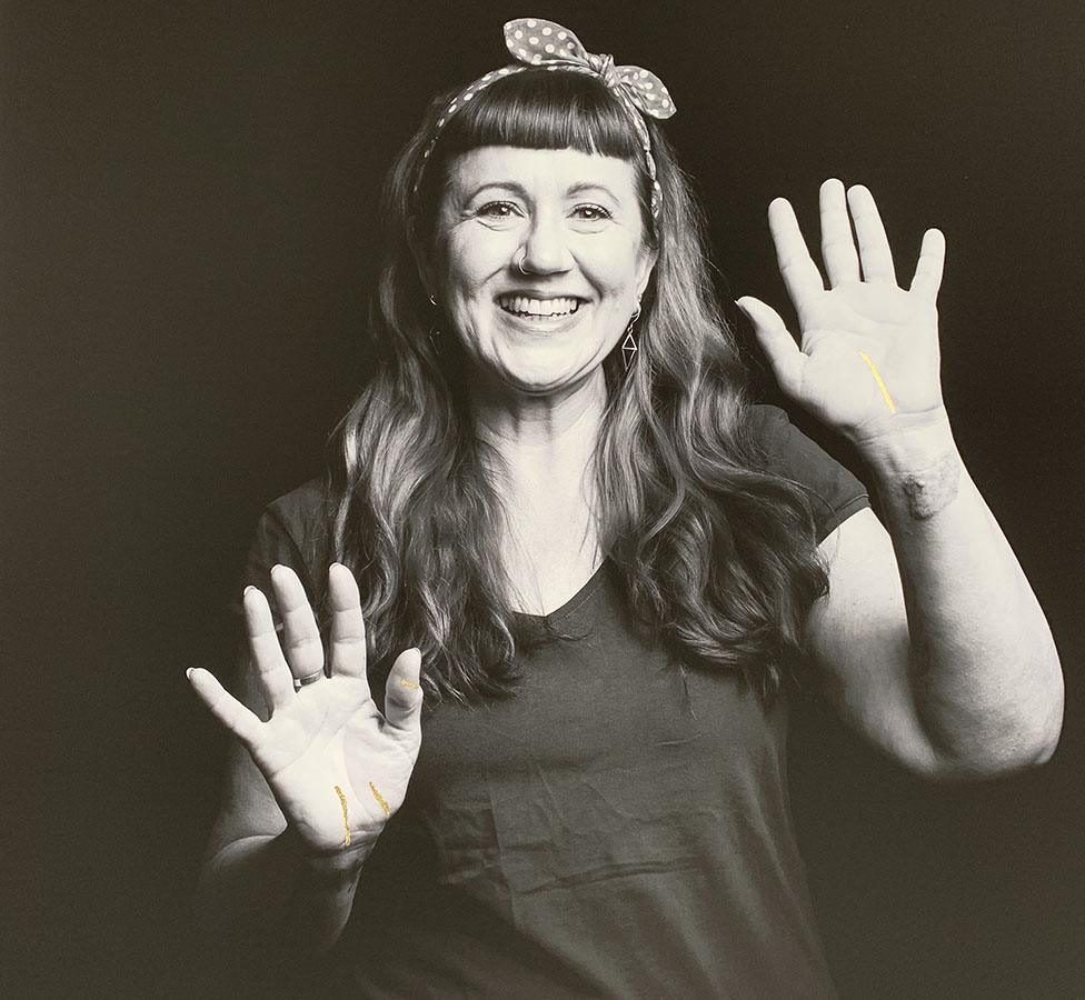 A black and white image of a female patient with a scar on her hands filled in with gold leaf