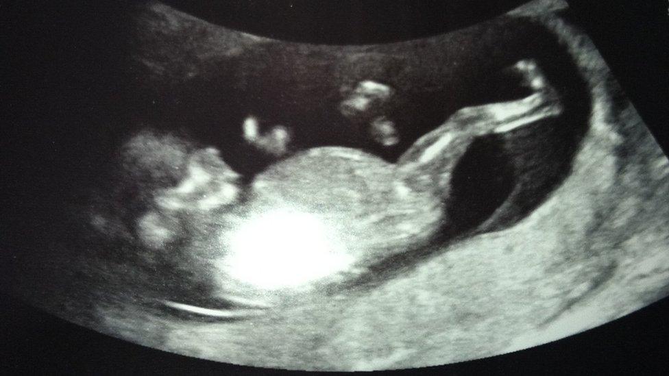 Ella's baby scan