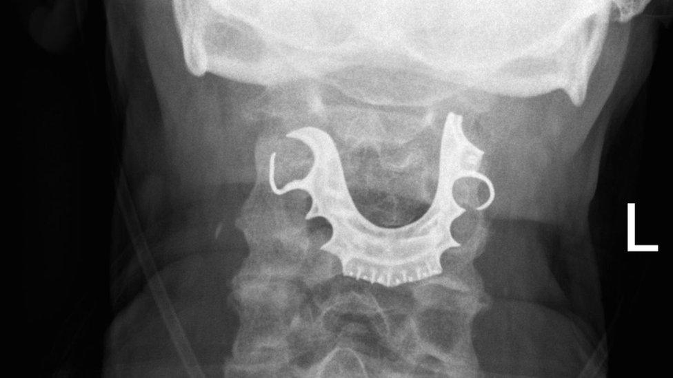 Dentures in throat x-ray