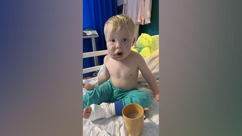 A child with blonde hair and green trousers sits on a hospital bed with a badly swollen face. 