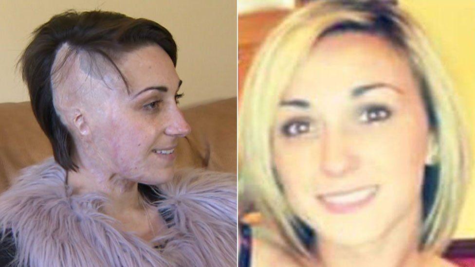 A composite image of Adele Bellis before and after her attack. On the left she is showing the side of her head which was burned by the acid, she lost an ear and the hair on that side. She is wearing a fluffy purple jacket and has short brown hair. On the other side is an image of her smiling at the camera before the attack, she has blonde hair and is smiling at the camera. 