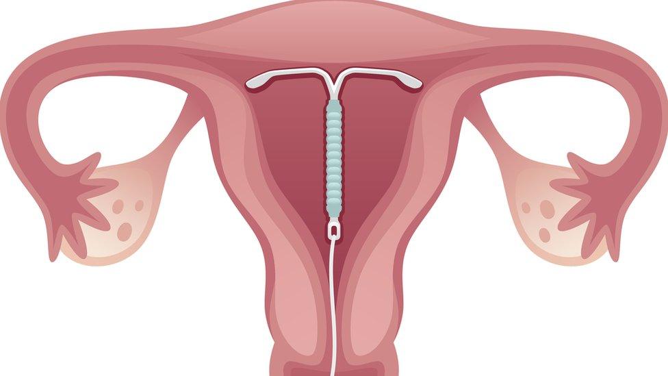 diagram showing coil in the womb