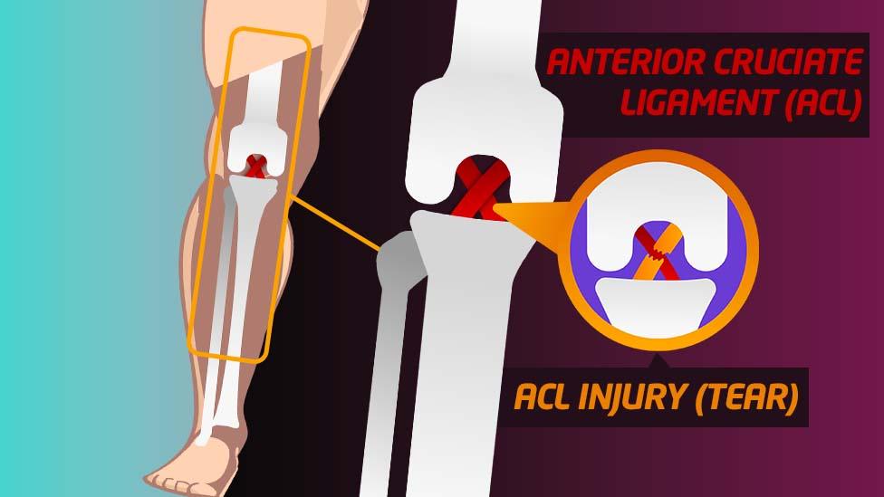 ACL injury graphic