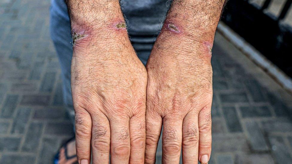 detainee shows cuts on wrists after release