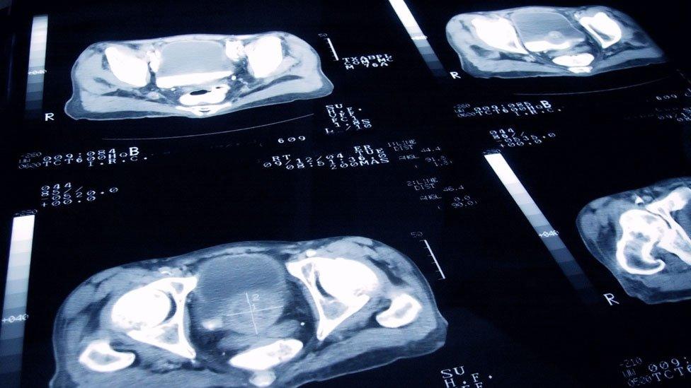 Prostate cancer slides