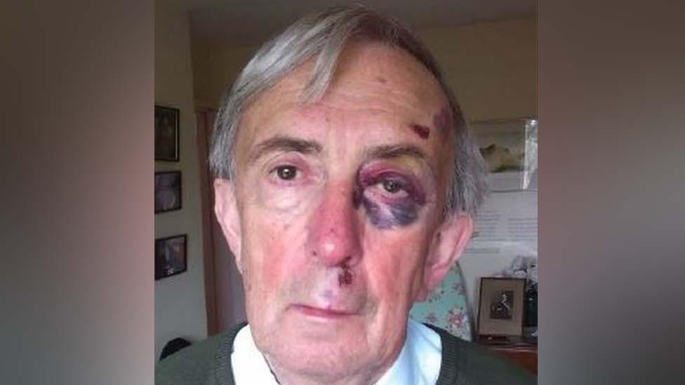 Peter Farquhar with a black eye