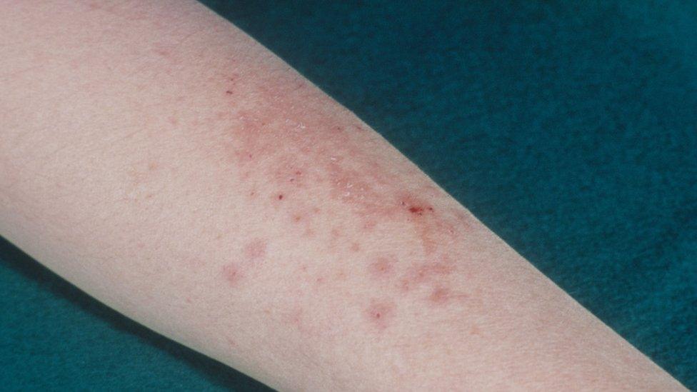 Eczema on an arm