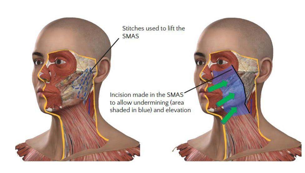 A diagram showing how a facelift is carried out. There are two images of a face and neck with cross sections showing under the skin