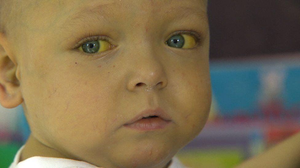 Two-year-old Zachary Bradford looks into the distance, his blue eyes tinged in yellow from his liver condition