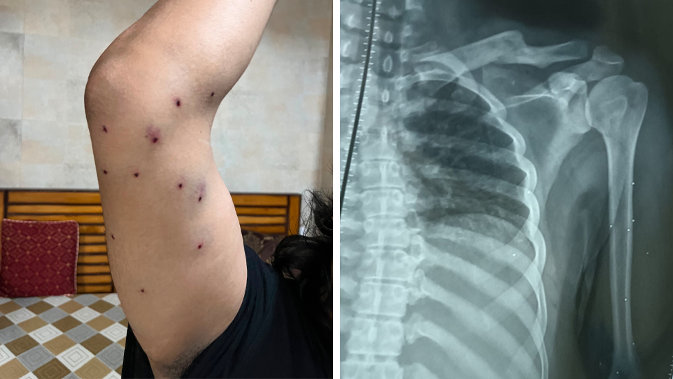 A 28-year-old journalist has shared his photos and X-ray with the BBC 