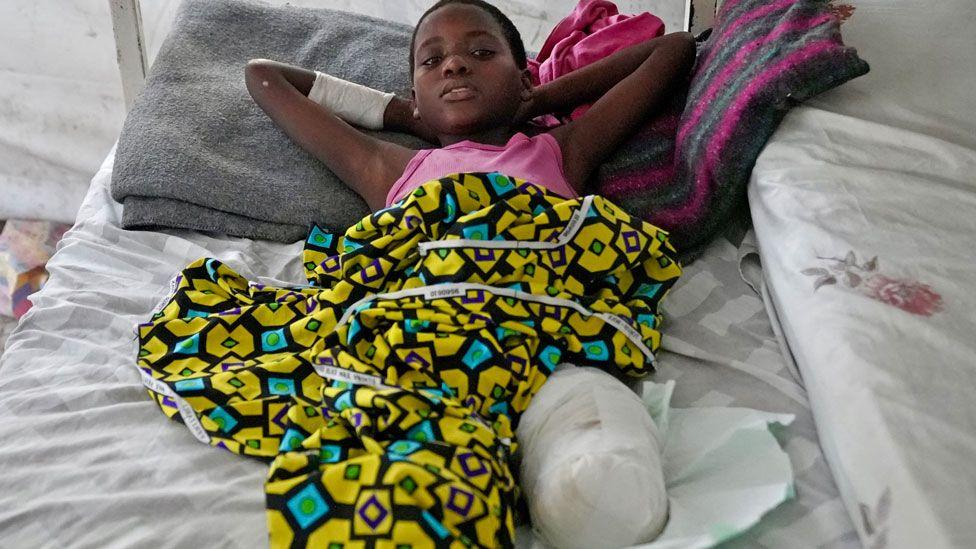 Heshima, a child amputee, lying in bed in Ndosho Hospital in Goma. He is wearing a pink sleeveless top and his body is covered by a colourful wrap. His stump is bandaged and he looks at the camera with his hands behind his head.