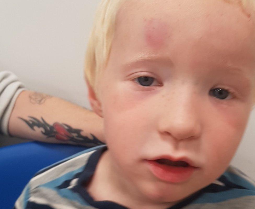 Jack Hall, 4, after being struck by white board