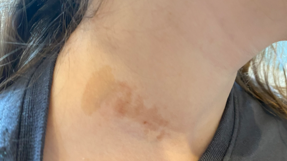 Cafe au Lait mark on Marissa's neck