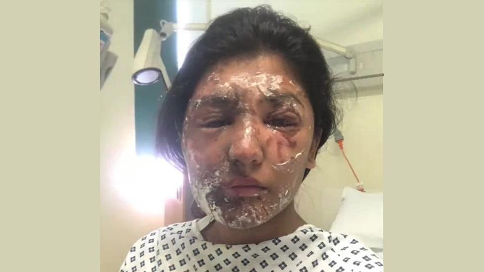 Resham Khan with facial burns