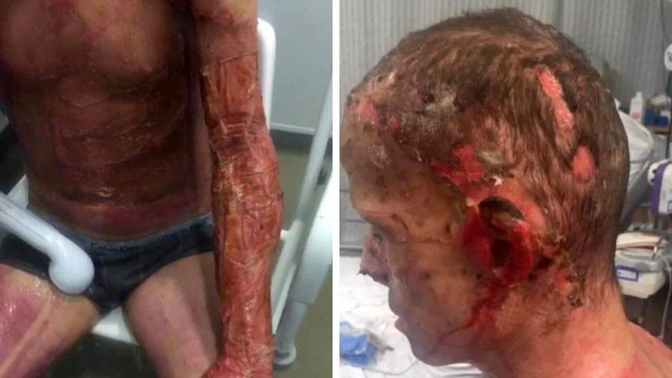 Composite image showing the extent of Darren Harris's burns, including to his legs, arms, abdomen and head