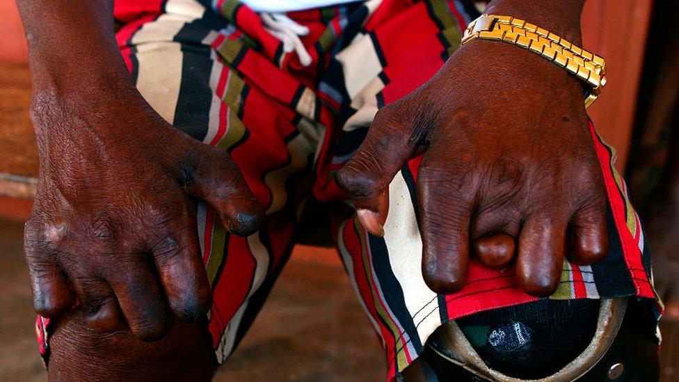 Man in Nigeria with leprosy