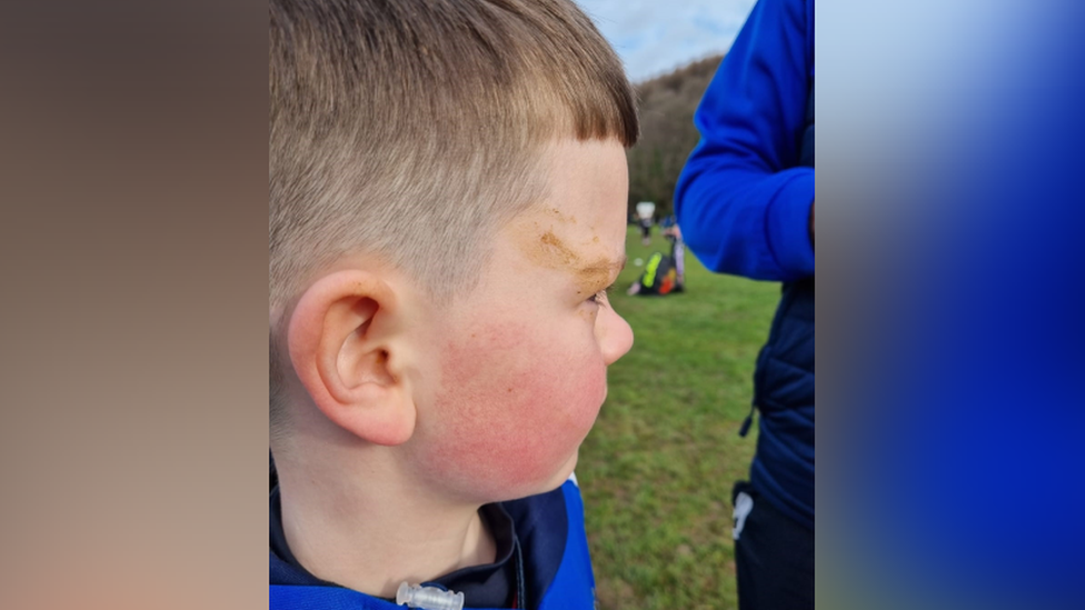 Youth rugby player with dog mess on his face