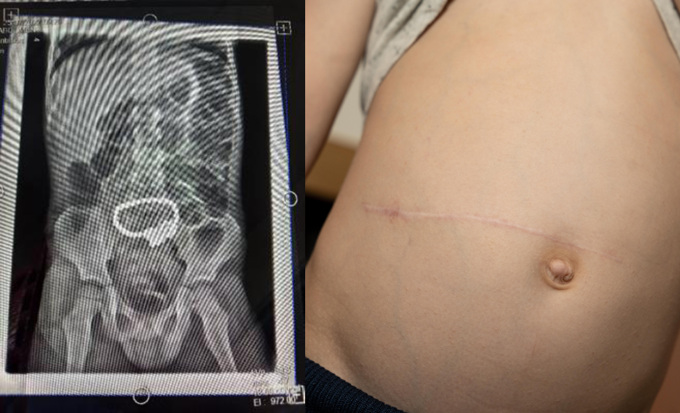 Jude's x-ray and five-inch scar