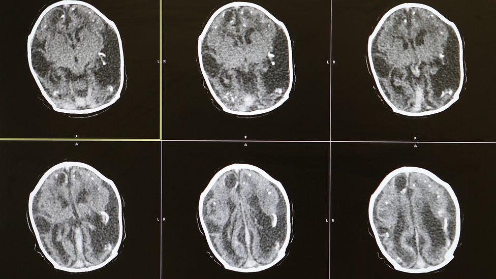 Brain scans of a 2-month-old baby with microcephaly.