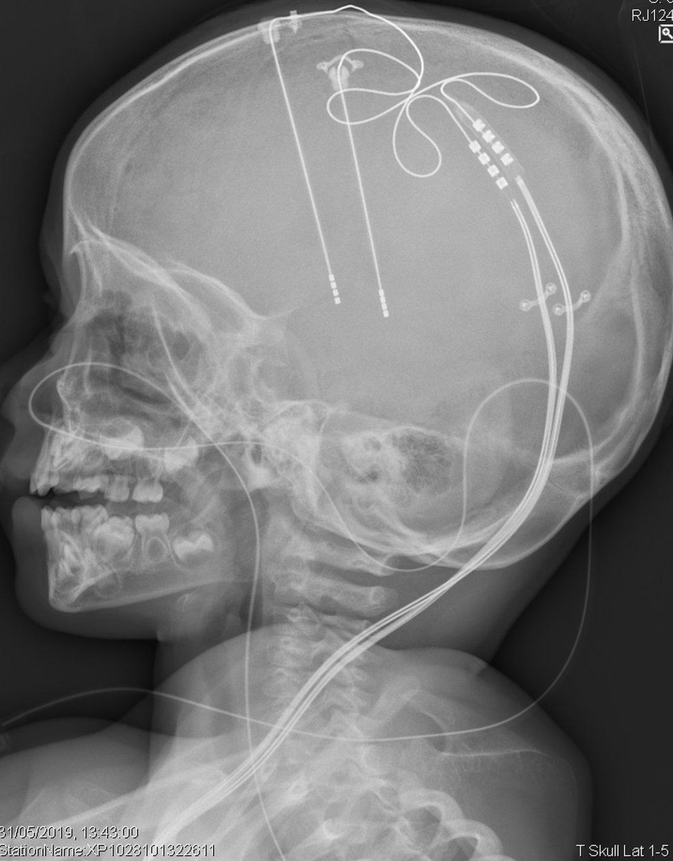 The electrodes were inserted deep in the brain into the area which controls movement