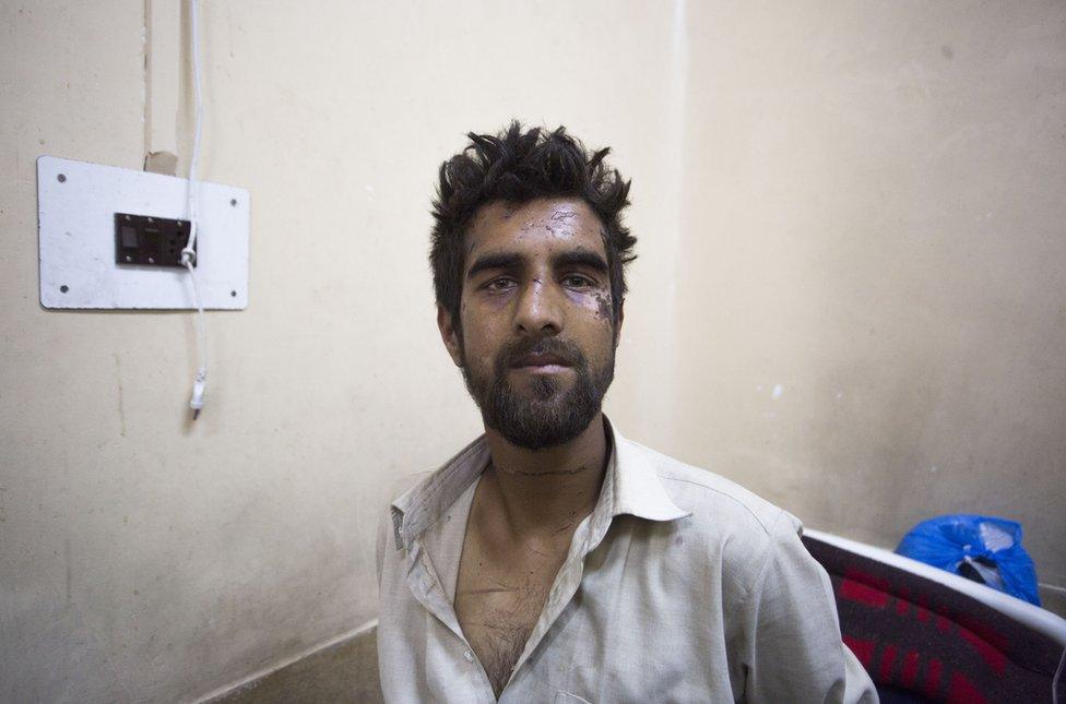 Waseem Ahmad's face is bruised from a beating in which he was accused of being the "braid chopper"