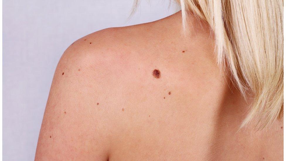 A mole on a lady's back