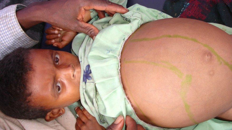 Child with leishmaniasis