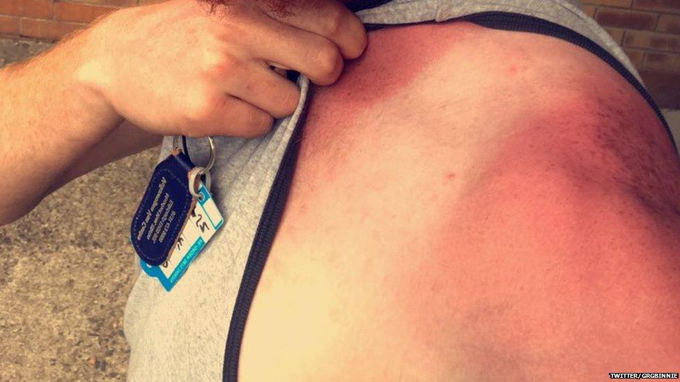 Greg Binnie got sun burnt