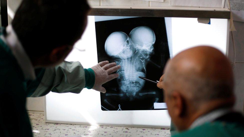 Doctors look at the X-ray showing conjoined twin boys born in Sanaa, Yemen (6 February 2019)