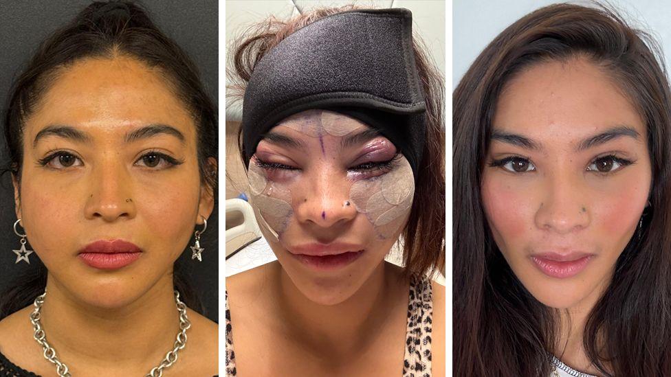 A composite of Julia before and post surgery. In the before picture she is looking at the camera and wearing silver star earrings and a silver chain necklace. In the middle picture she has plasters on her face and some pen marks can still be seen. Her eyes are puffy and purple. The third picture shows her with no bandages or plasters. Her long dark hair hangs either side of her face.