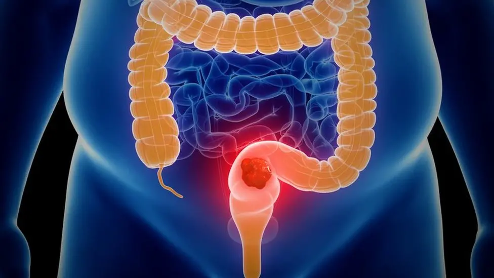 A CGI image of a colon and rectum, with the organs highlighted 