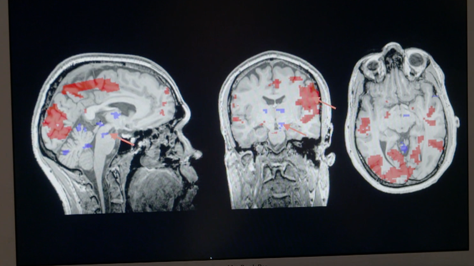 Brain scans