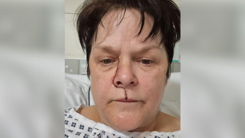 A selfie of Melanie Wellings lying in a hospital bed wearing a blue and white patterned gown. She has short dark brown hair, and is looking slightly down at the camera. She has just undergone surgery, and has a thin red scar and stitches across her face, running from her inner left eye, around her nose and down the middle of her top lip. 