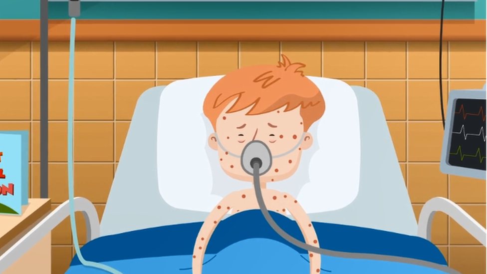 A cartoon of a young boy with measles