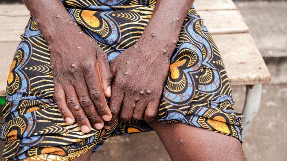 What is mpox, what are the symptoms and which countries is it in? - BBC ...