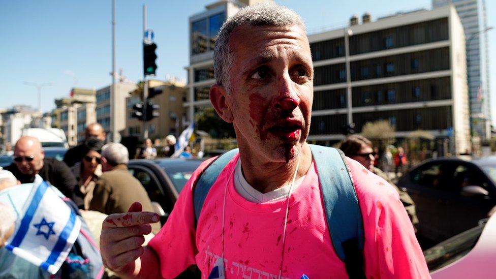 Anti-government protester Shay Noter, who suffered a broken nose and bloodied face, after being attacked by a driver near the British embassy in Tel Aviv, Israel (16 March 2023)