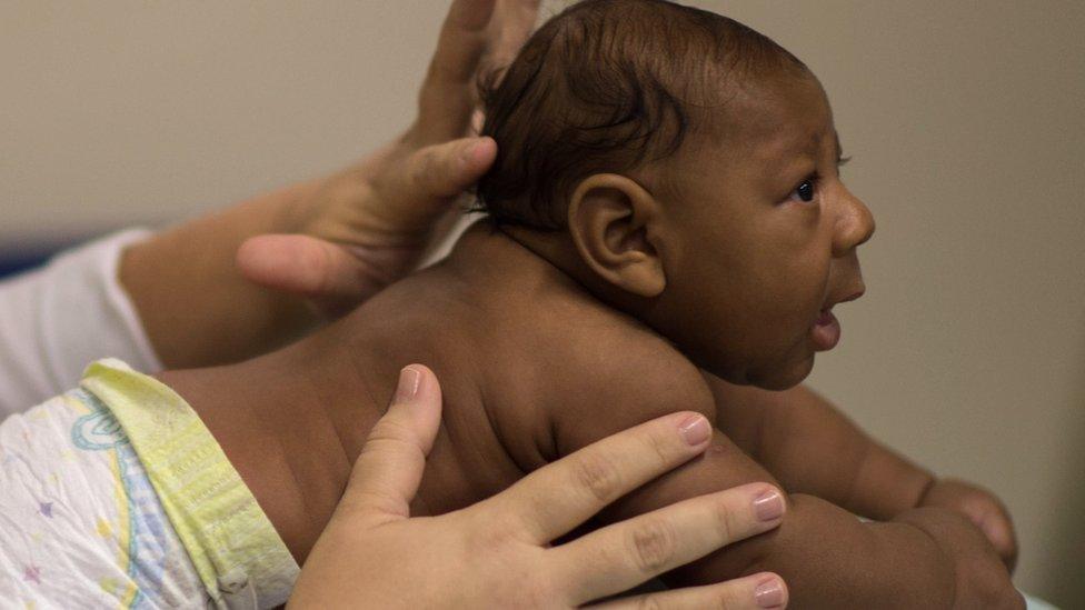 A baby born with Zika virus in Brazil